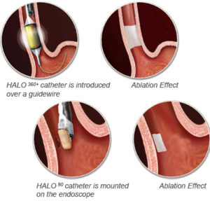 Barrett's Esophagus Treatment with RFA - Advanced Gastroenterology ...